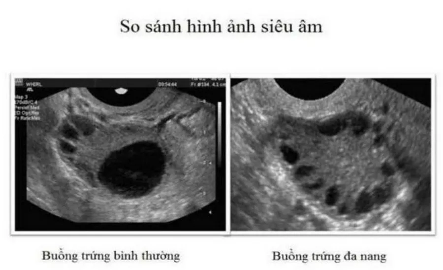 Hình ảnh siêu âm buồng trứng đa nang