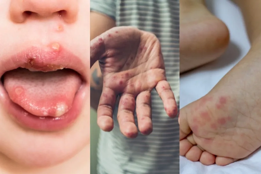 Nốt mụn nước gây đau đớn, khó chịu