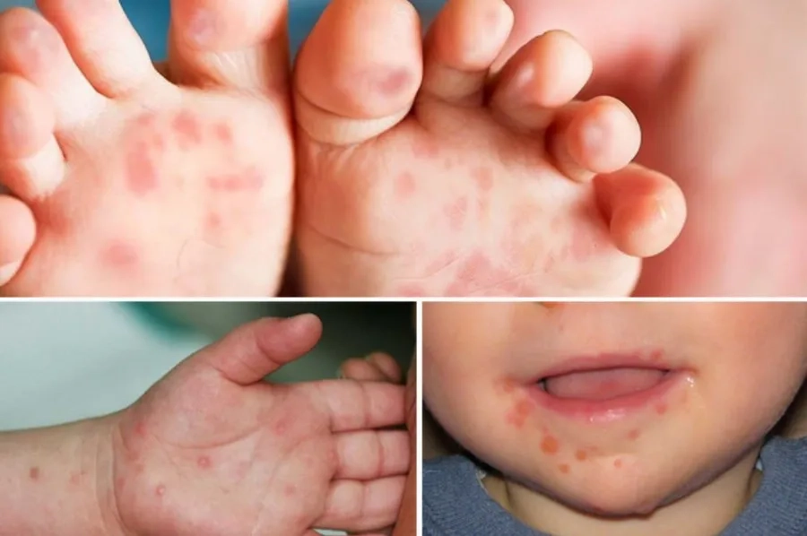 Nốt bọng nước xuất hiện quanh miệng, lòng bàn tay và bàn chân