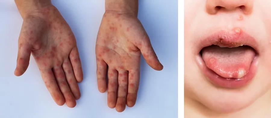 Mụn nước xuất hiện ở bàn tay, bàn chân và khoang miệng