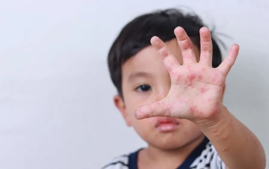 Trẻ mệt mỏi, sốt nhẹ, nổi mụn nước tại miệng, tay, chân