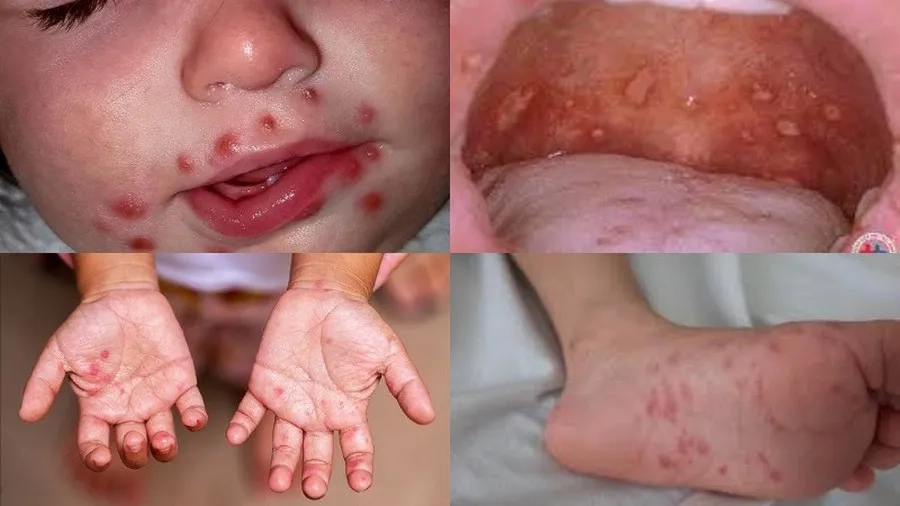 Hình ảnh tay chân miệng bọng nước lan rộng