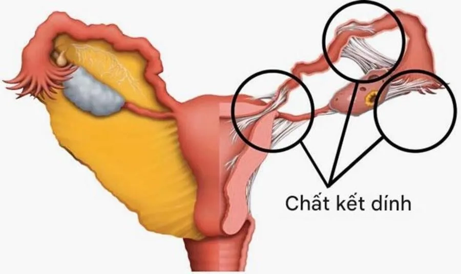 Tổn thương kéo dài có thể gây viêm dính vùng chậu và ảnh hưởng chức năng sinh sản