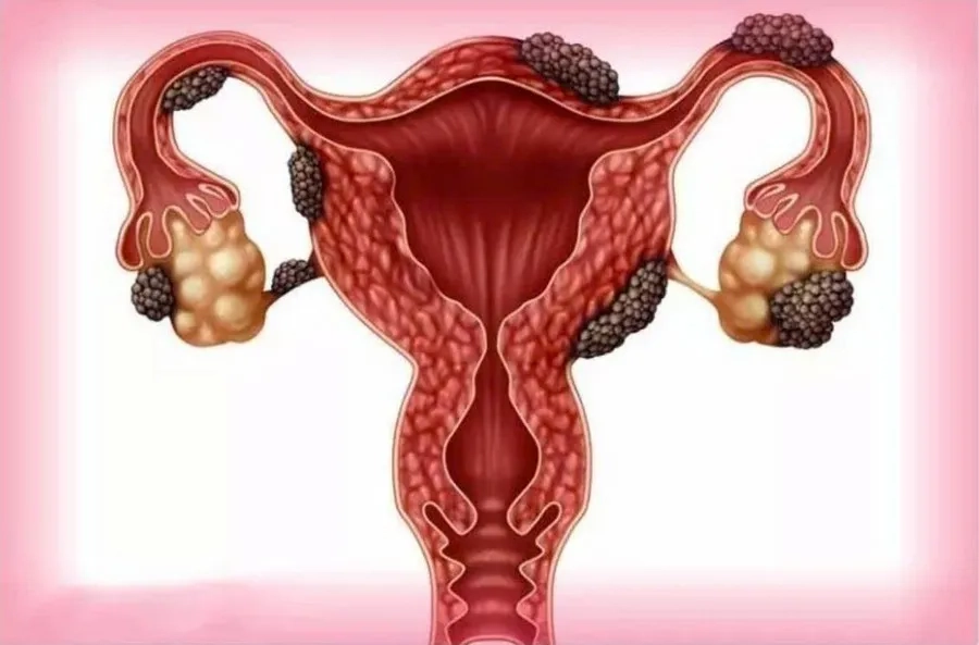 Hình ảnh minh họa mô nội mạc phát triển lạc chỗ tại buồng trứng