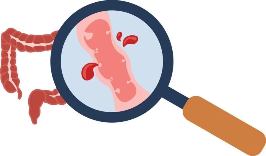 Xuất huyết tiêu hóa là biến chứng thường gặp ở các trường hợp giảm tiểu cầu mức độ nặng