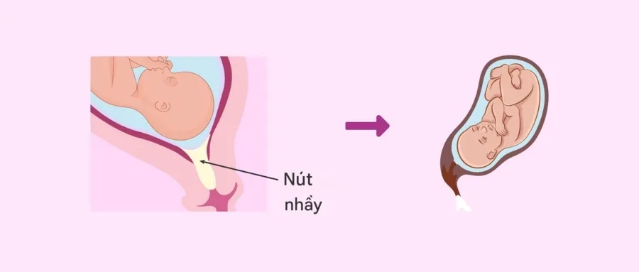 Bong nút nhầy cổ tử cung là thay đổi sinh lý bình thường ở giai đoạn cuối thai kỳ