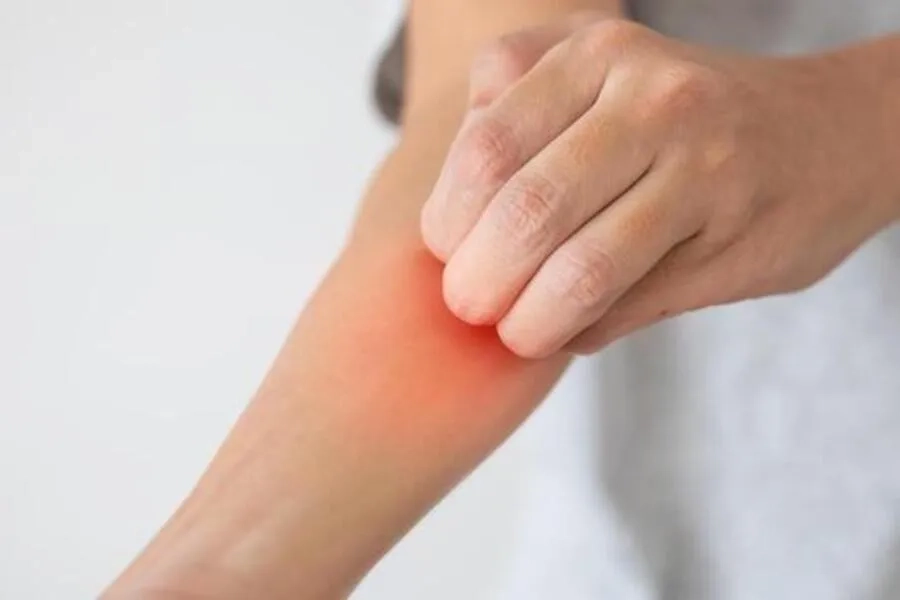 Bạn không nên gãi mạnh hoặc gãi liên tục, vì có thể gây xuất huyết dưới da và tăng nguy cơ nhiễm trùng