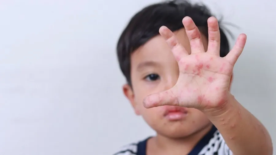 Virus tay chân miệng có thể lây lan nhanh trong cộng đồng 