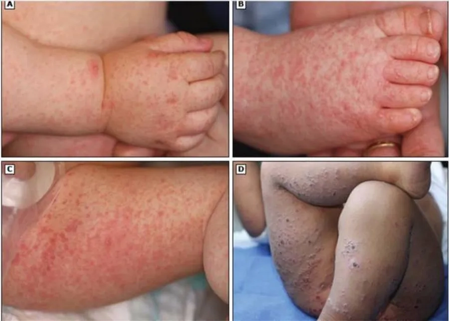 Hình ảnh bệnh tay chân miệng gây bọng nước ở tay, chân, mông bé