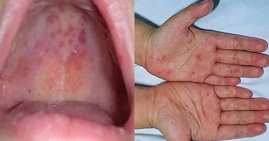 Bệnh tay chân miệng do virus thuộc nhóm Enterovirus gây nên các nốt bóng nước ở miệng, bàn tay, bàn chân