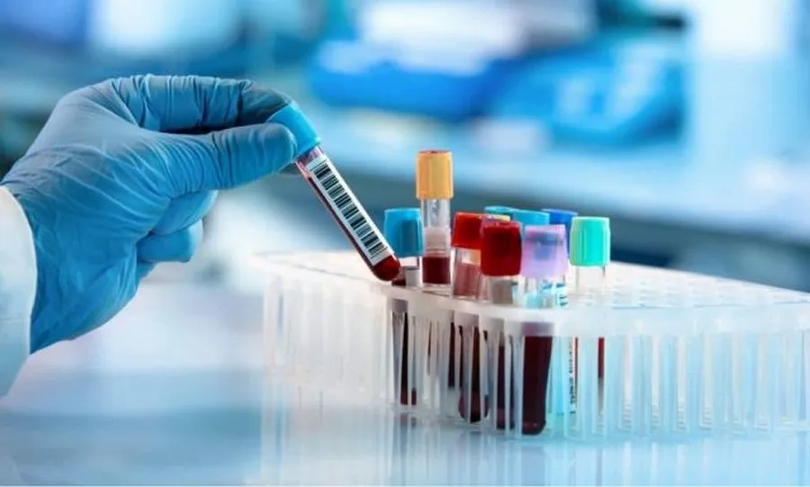 Xét nghiệm máu giúp chẩn đoán biến chứng bệnh chân tay miệng