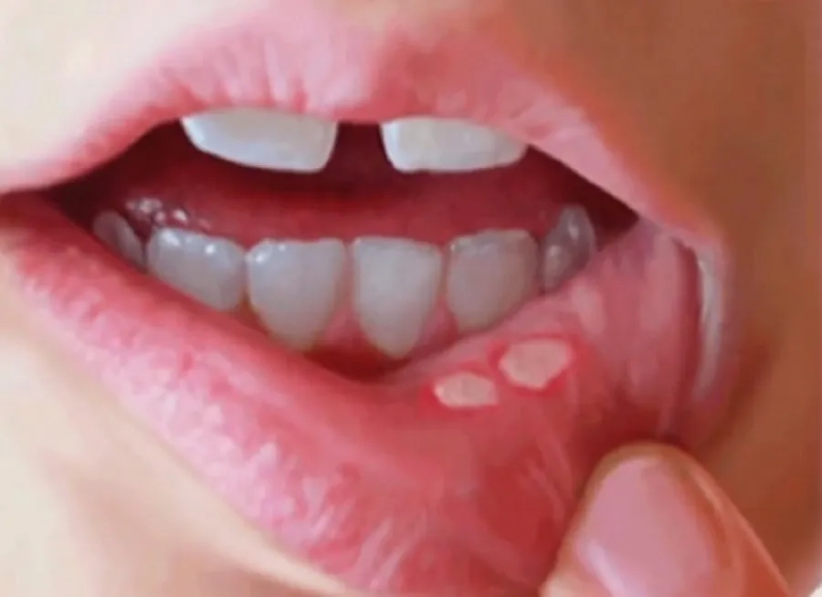 Vết loét trong bệnh tay chân miệng cần được phân biệt với nhiệt miệng