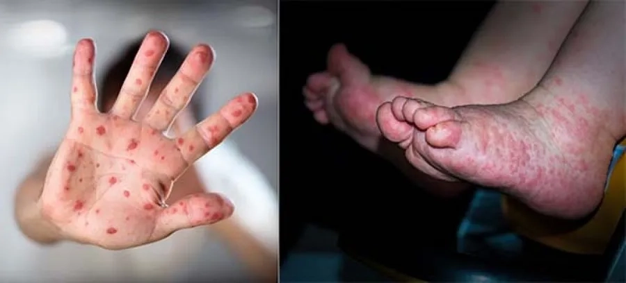 Biểu hiện phổ biến của bệnh là xuất hiện bọng nước ở bàn tay, bàn chân, quanh miệng, trong miệng 