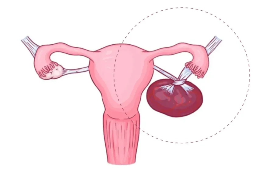 Xoắn nang có thể làm tổn thương mô lành của buồng trứng, giảm khả năng sinh sản