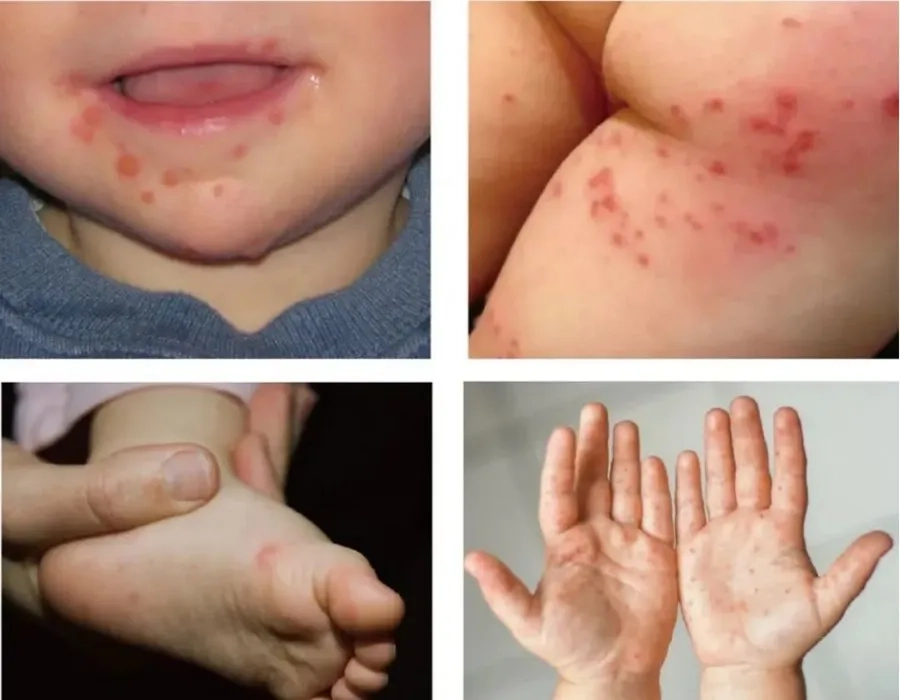 Các nốt bọng nước dày đặc tại lòng bàn tay, bàn chân, miệng