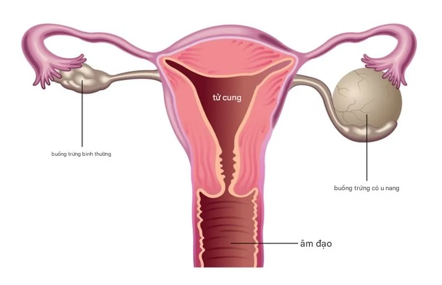 U nang buồng trứng nhỏ (dưới 5 cm) thường lành tính và có thể tự thoái triển