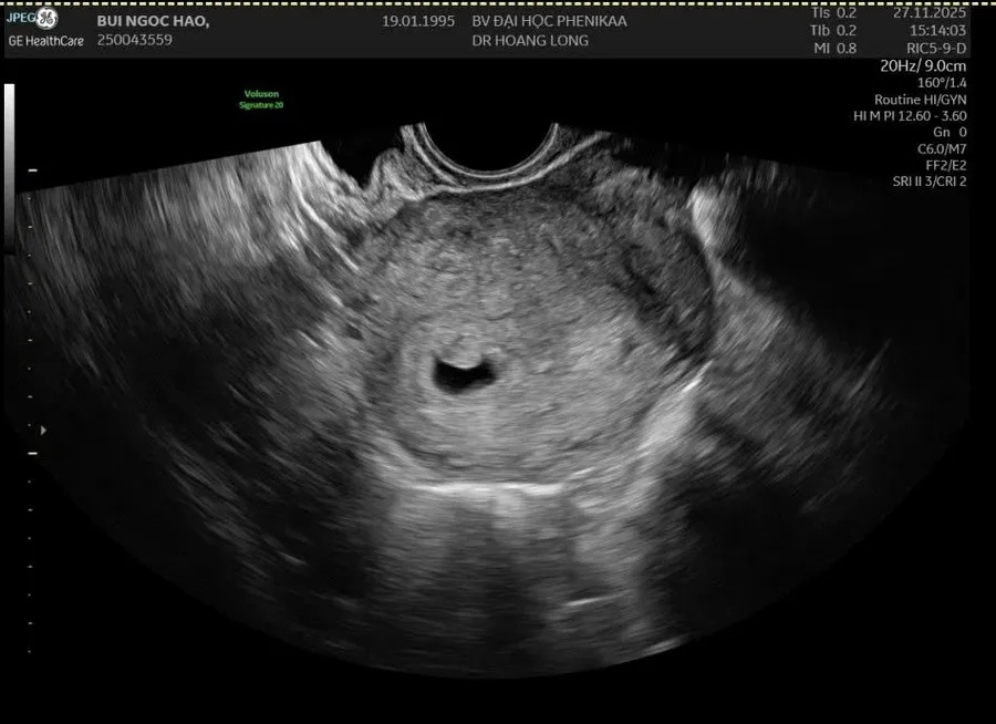 Túi ối méo là dấu hiệu bất thường cần được theo dõi kỹ lưỡng để bảo vệ sức khỏe thai nhi