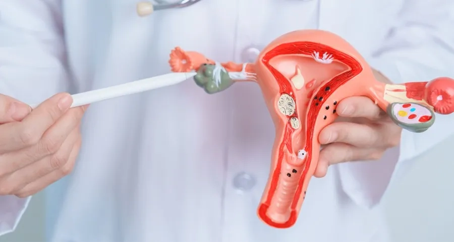 Hình ảnh minh họa vị trí khối u xơ trong cấu trúc buồng trứng