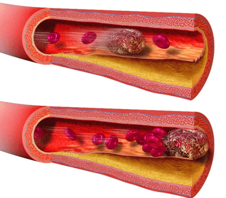 Thuyên tắc mạch ối là một biến chứng hiếm gặp nhưng có thể gây hậu quả nghiêm trọng