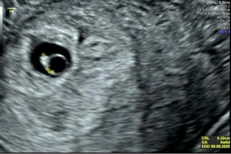Hình ảnh túi ối nhỏ hơn so với tuổi thai