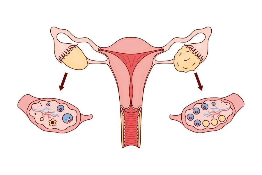 Số lượng nang buồng trứng giảm dần theo tuổi của phụ nữ