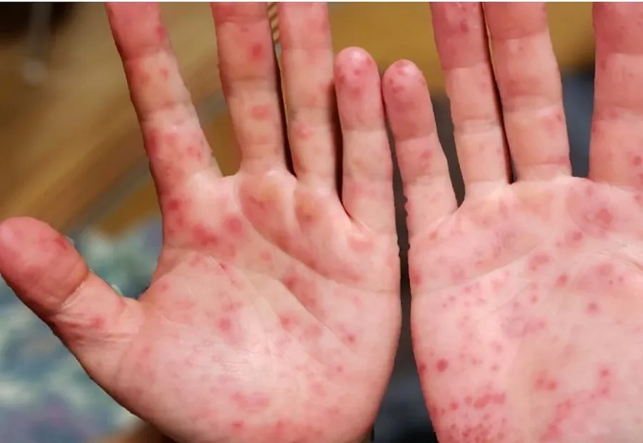 Nổi ban phỏng nước ở tay là biểu hiện của bệnh tay chân miệng