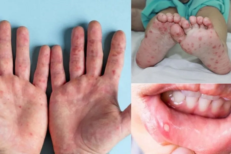 Hình ảnh bệnh tay chân miệng độ 3: bọng nước nhiều, trẻ mệt mỏi, khó chịu