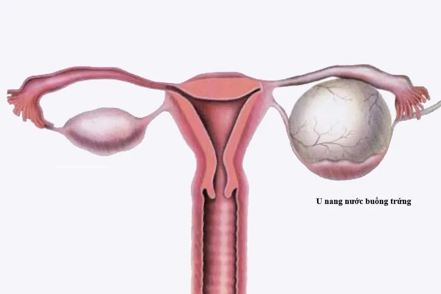 Hình ảnh minh họa u nang nước buồng trứng chứa dịch trong