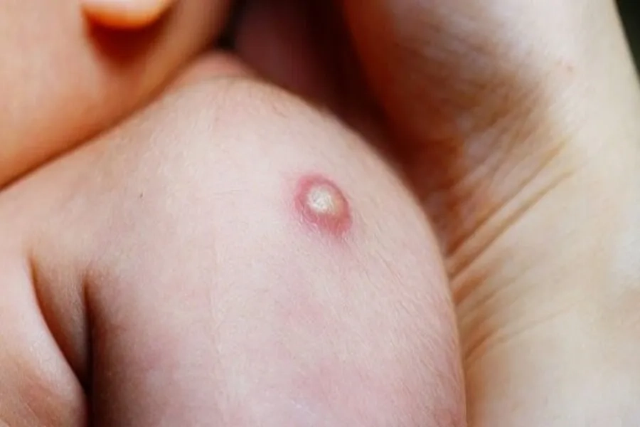 Sau 4-6 tuần tại vết tiêm có xuất hiện mủ trắng