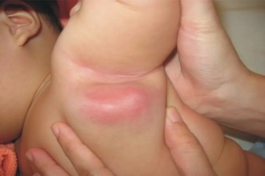 Xuất hiện hạch nách sưng to khiến trẻ đau đớn, quấy khóc là biểu hiện bất thường sau tiêm lao