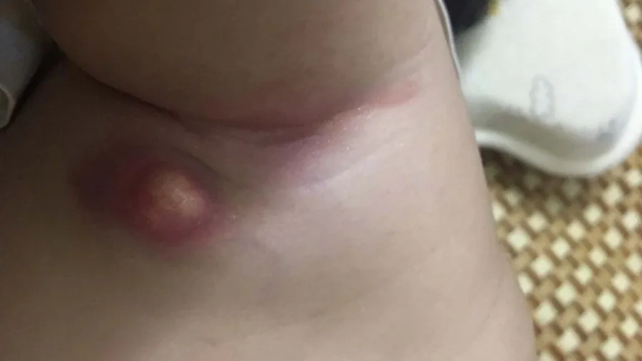 Tình trạng viêm hạch nách sau tiêm cần được theo dõi và xử trí bởi bác sĩ chuyên khoa