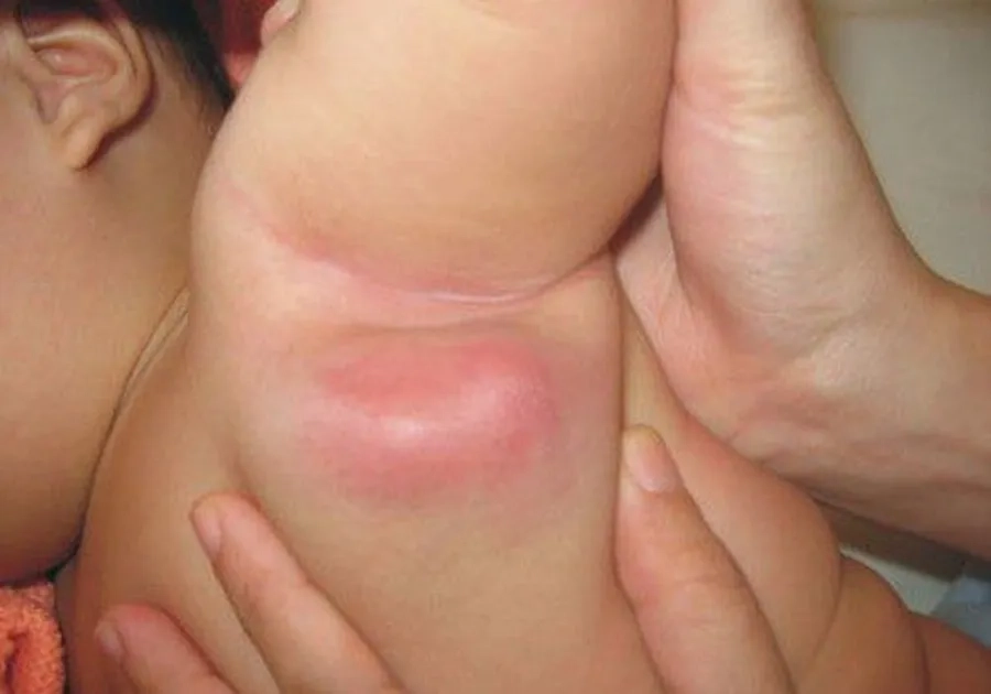 Hạch nách sưng to sau tiêm BCG là phản ứng bất thường cần được xử trí sớm 