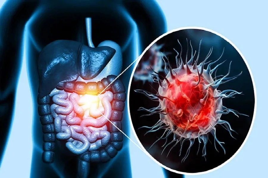 Các giai đoạn ung thư đại tràng giúp bác sĩ đánh giá mức độ bệnh và lựa chọn phương pháp điều trị phù hợp
