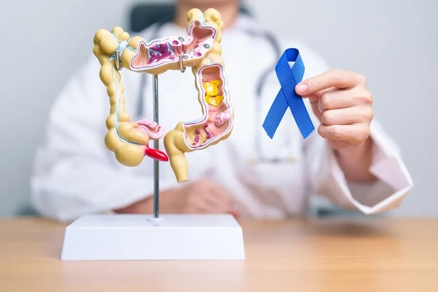 Ung thư đại tràng giai đoạn 0 thường không có triệu chứng và được phát hiện qua nội soi tầm soát