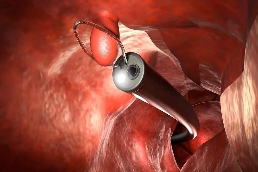 Điều trị ung thư đại tràng ở giai đoạn 0 thường chỉ cần cắt bỏ polyp hoặc vùng niêm mạc bất thường