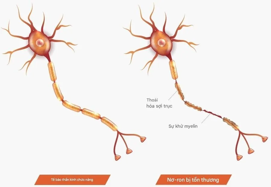 CMT type 2S là một thể bệnh hiếm thuộc nhóm rối loạn thần kinh ngoại biên di truyền, đặc trưng bởi tổn thương sợi trục thần kinh