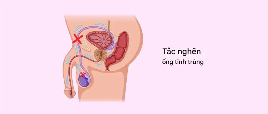 Tắc ống dẫn tinh có thể cản trở quá trình vận chuyển tinh trùng