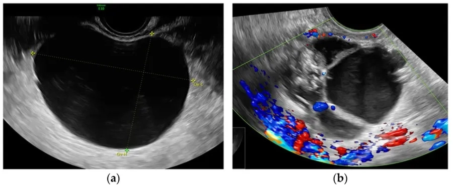 Hình ảnh siêu âm so sánh nang buồng trứng đơn giản, một ngăn, không phản âm (a) và nang buồng trứng phức tạp (b)