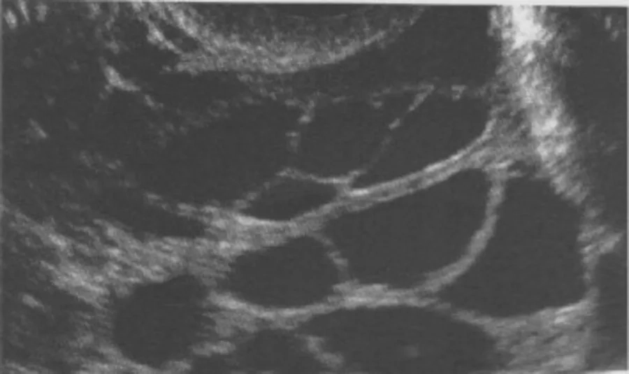 Hình ảnh minh họa nang đa thùy buồng trứng với nhiều khoang dịch bên trong