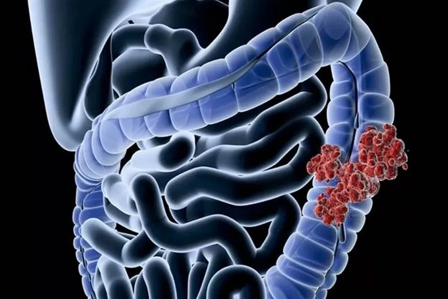 Hút thuốc lá và lạm dụng rượu bia làm gia tăng khả năng tổn thương đại tràng