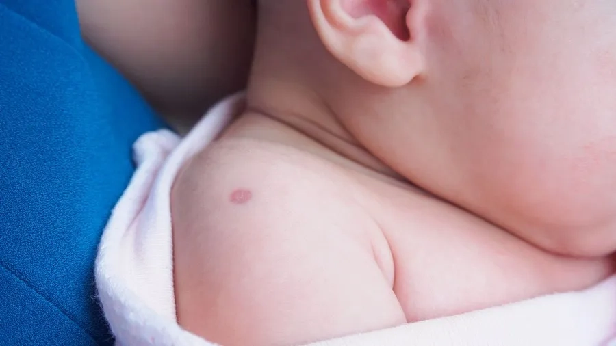 Sau một vài tháng tại vết tiêm sẽ để lại sẹo trên da của bé 