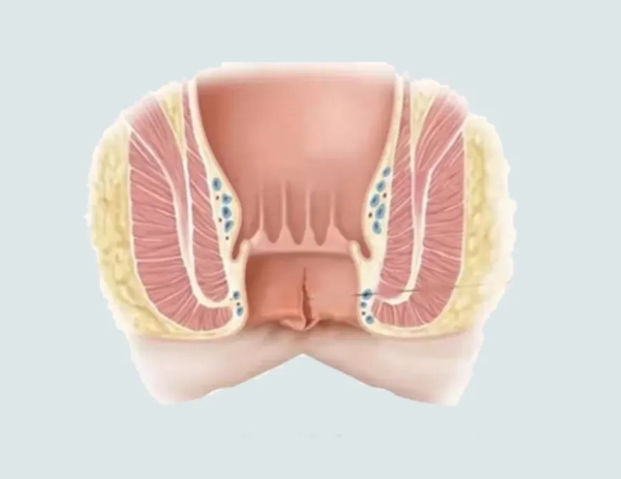 Nứt hậu môn là nguyên nhân thường gặp gây ra máu trong phân