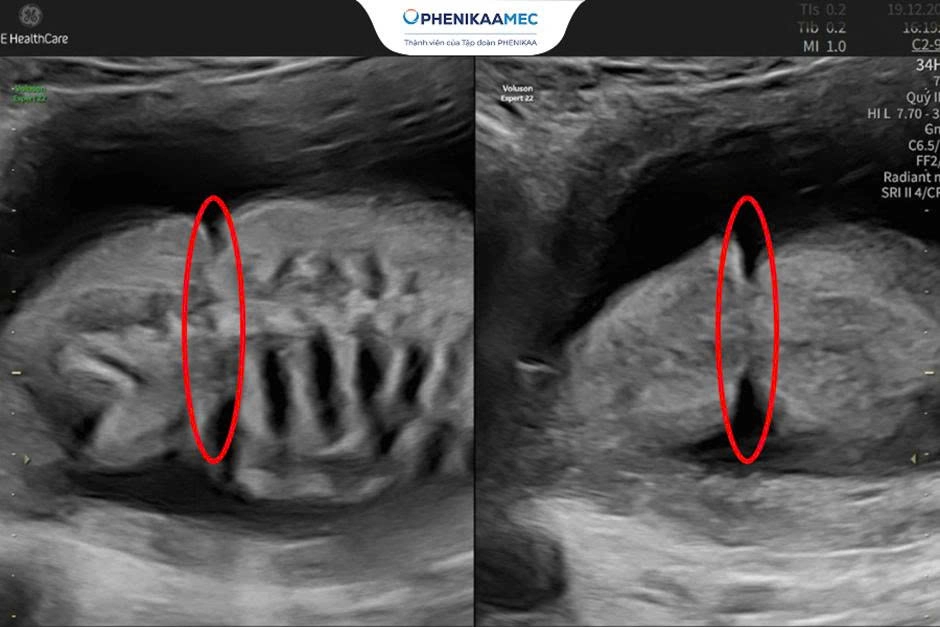 Từ nguy cơ đình chỉ thai kỳ đến cái kết trọn vẹn: 18 tuần theo dõi và chuyến bay đặc biệt đón em bé chào đời