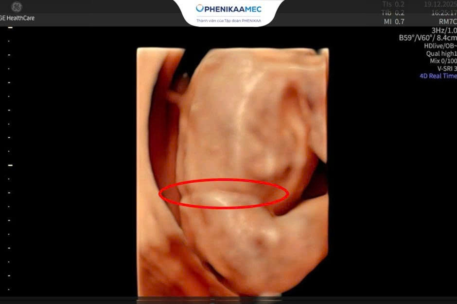 Từ nguy cơ đình chỉ thai kỳ đến cái kết trọn vẹn: 18 tuần theo dõi và chuyến bay đặc biệt đón em bé chào đời