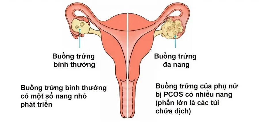 Buồng trứng đa nang có thể là nguyên nhân dẫn đến chỉ số AMH tăng cao