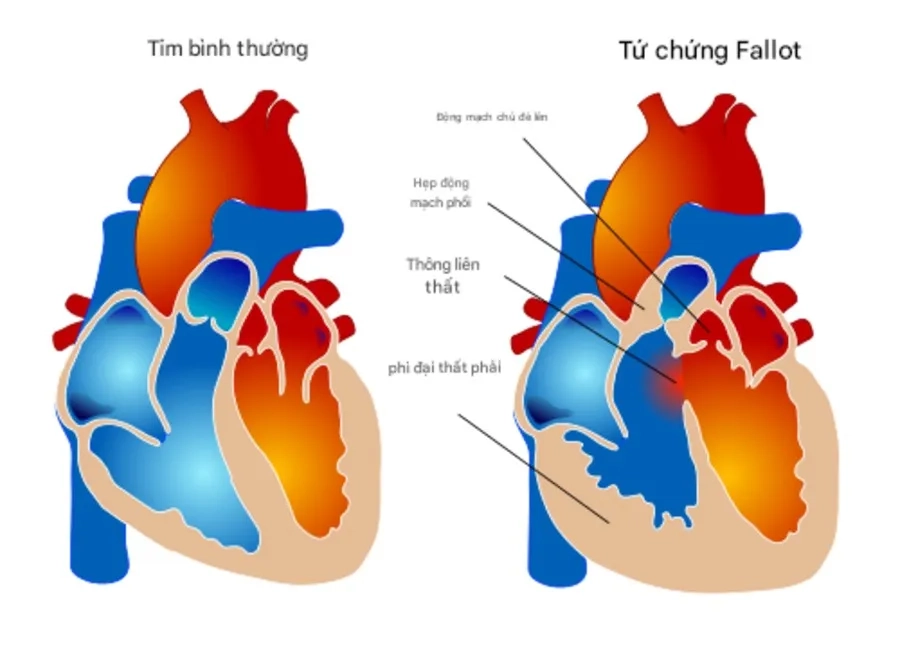 Tứ chứng Fallot là một dạng tim bẩm sinh phức tạp ở trẻ sơ sinh