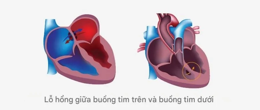 Tim bẩm sinh là tình trạng bất thường về cấu trúc của tim hoặc các mạch máu lớn