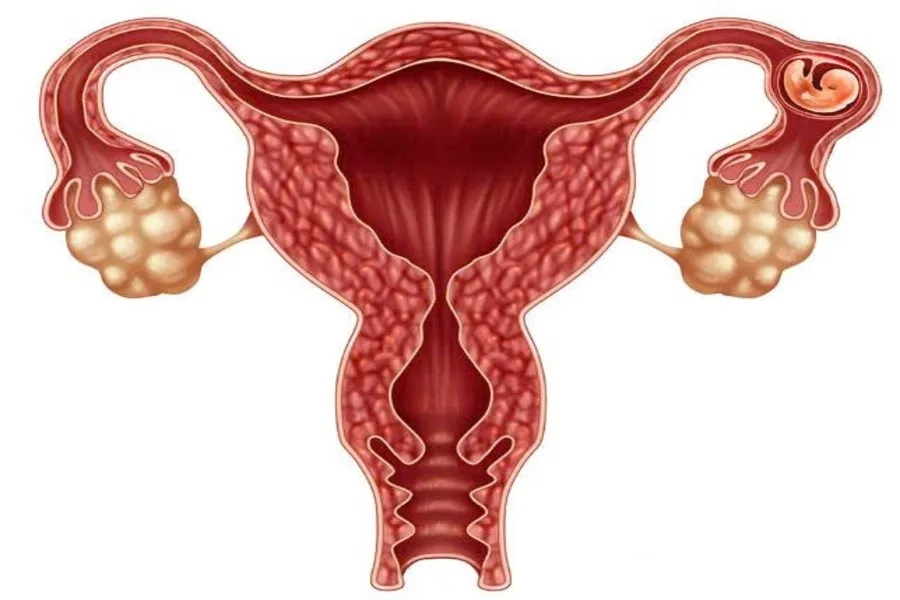 Vị trí thai không nằm ở tử cung được gọi là thai ngoài tử cung