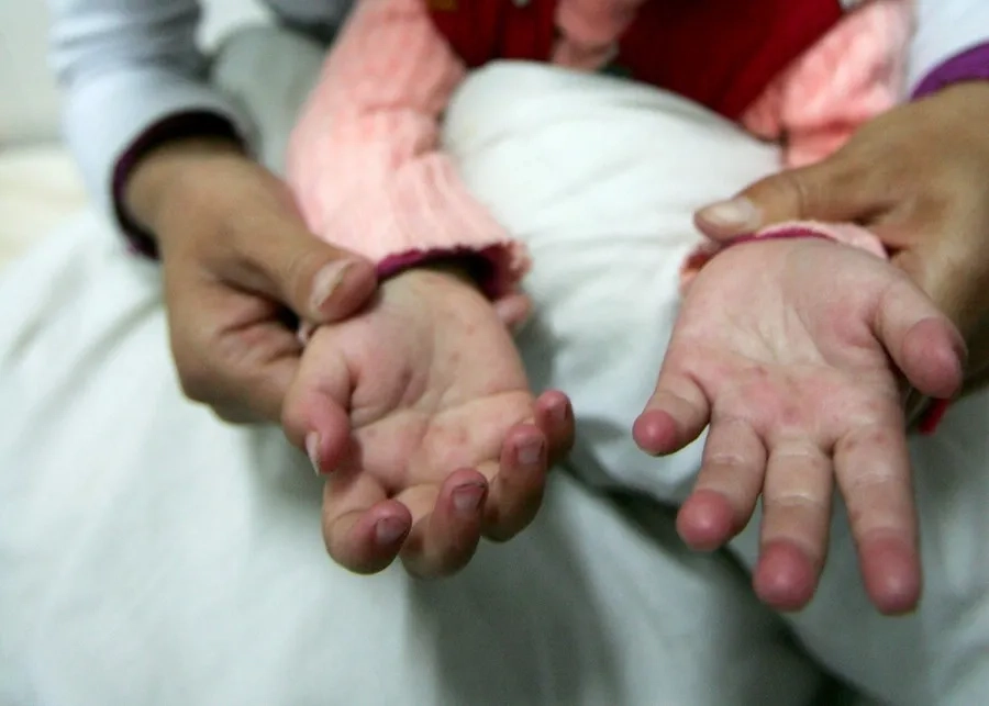 Trẻ bị tay chân miệng dù không sốt vẫn có thể lây lan virus cho cộng đồng