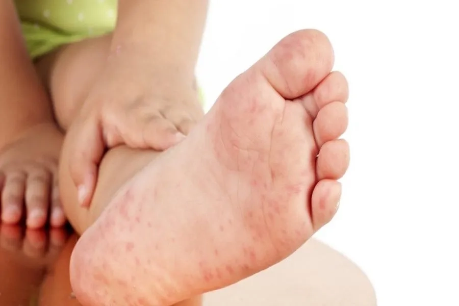 Trẻ đã từng bị tay chân miệng trước đó khi mắc bệnh lần sau có biểu hiện nhẹ hơn